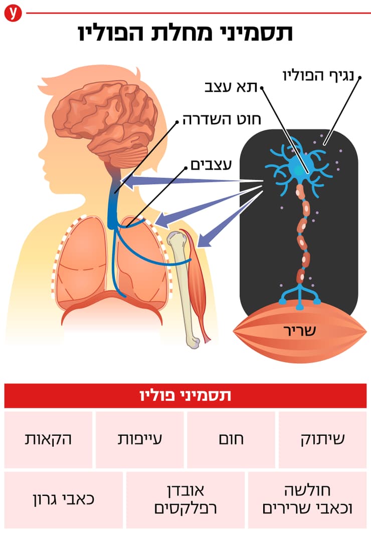 אינפו תסמיני פוליו אינפו תסמיני פוליו