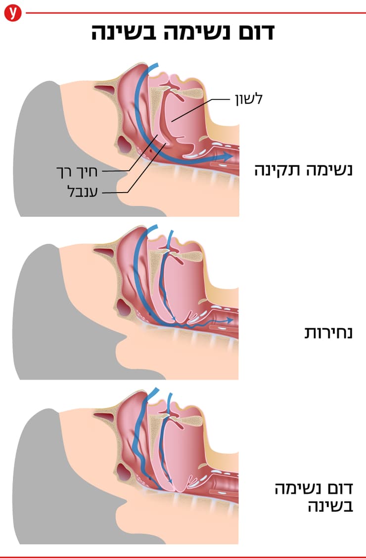 דום נשימה בשינה