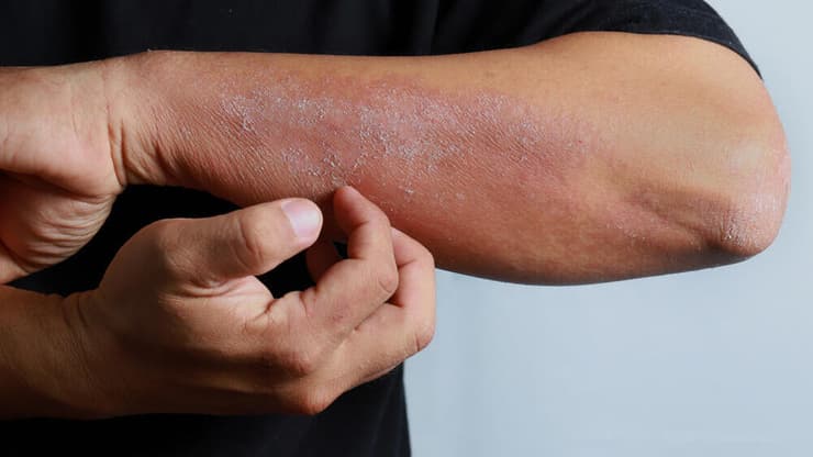 אטופיק דרמטיטיס