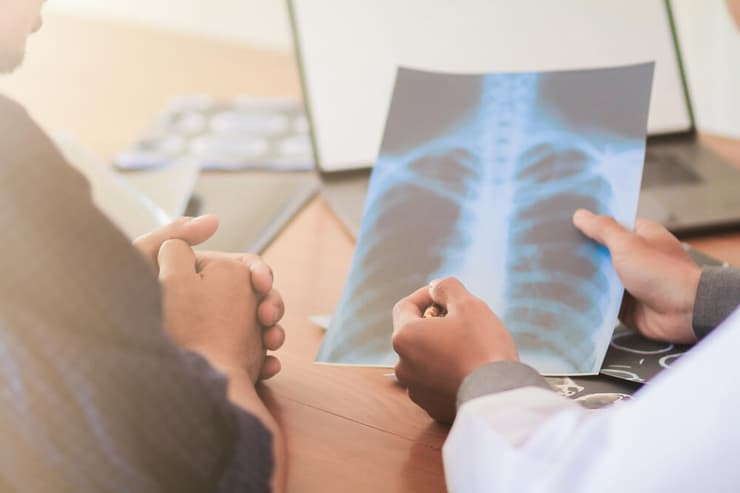 סרטן הריאה (צילום: shutterstock) סרטן ריאות ריאה