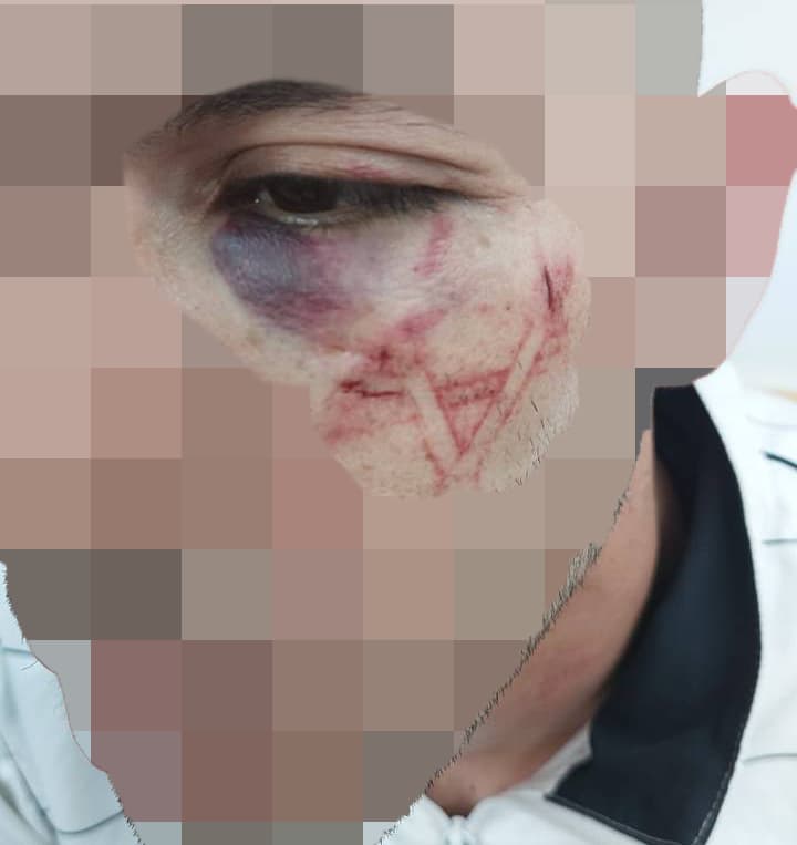 א' תושב מזרח ירושלים החשוד בעבירות סחר בסמים פצוע במעצרו