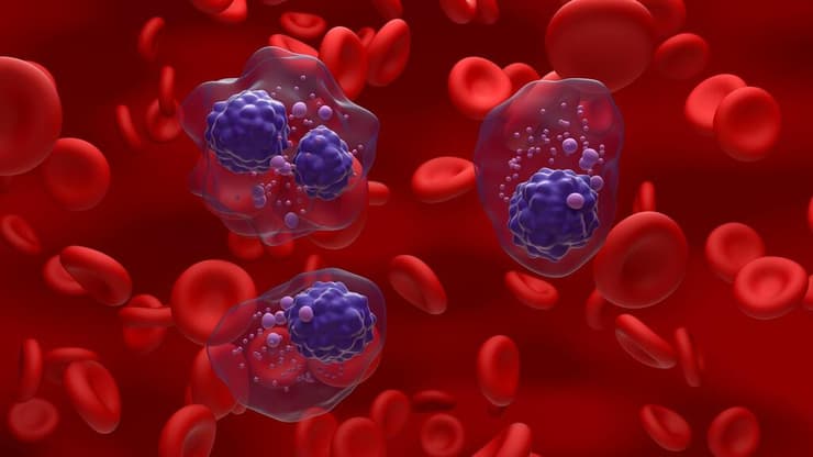 תאים סרטניים במיאלומה נפוצה