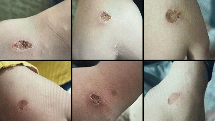 הסימנים שנמצאו על הילדים לאחר שהמדריך כיבה עליהם סיגריות