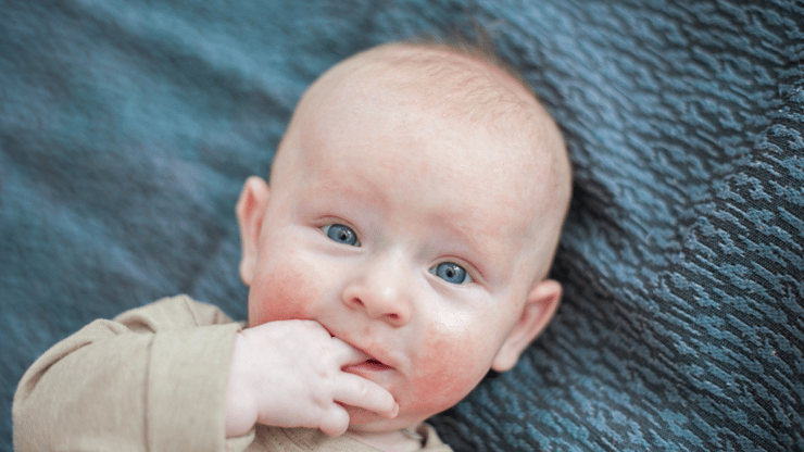 אטופיק דרמטיטיס