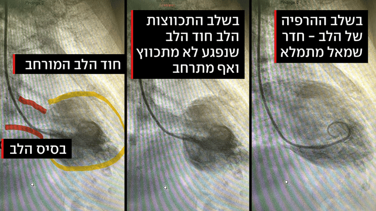 אינפו תסמונת הלב השבור