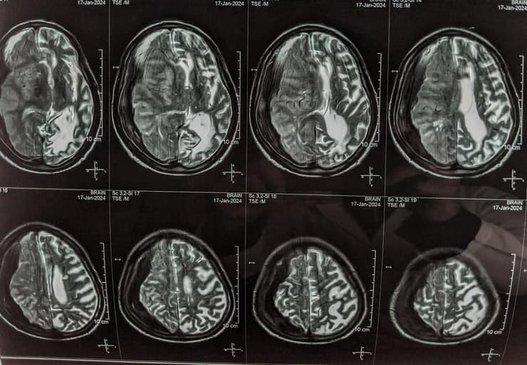 צילום הדמיה בעקבות שבץ מוחי