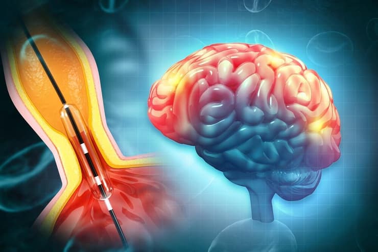 צנתור מוח בעקבות שבץ מוחי