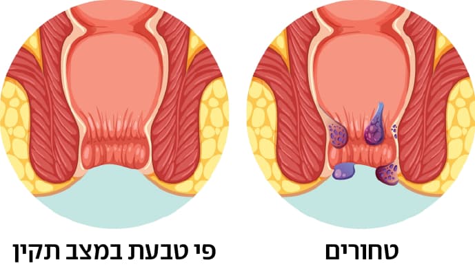 טחורים (צילום: shutterstock) טחורים