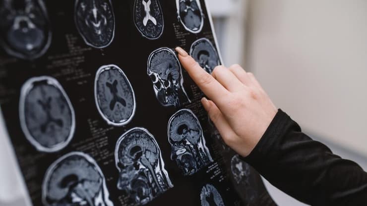 כדי למנוע דמנציה, חשוב לאזן ולמנוע מחלות כלי דם שעלולות לפגוע ברקמת המוח (צילום: shutterstock) צילום MRI של מוח