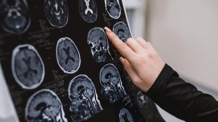 צילום MRI של מוח. משך הזמן לפענוח הבדיקות עולה בהתמדה בגלל המחסור ברופאים רדיולוגים (צילום: shutterstock) צילום MRI של מוח