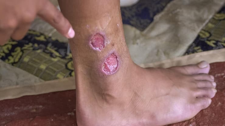 "הזן של אופקים נחשב לקל יותר ובדרך כלל אחרי כחצי שנה הנגעים יחלפו בלי טיפול". אילוסטרציה (צילום: Shutterstock) שושנת יריחו, לישמניה, מחלת עור. אילוסטרציה