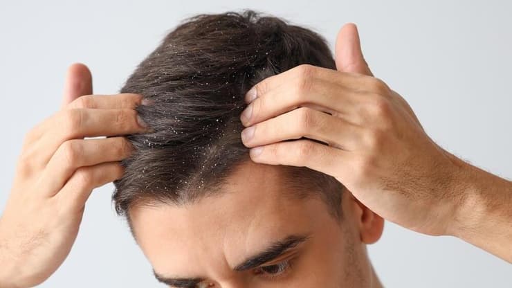 המים החמים עלולים להחמיר את תופעת הקרקפת היבשה, דבר שמתבטא בקשקשים ובעור מגרד (צילום: Shutterstock) קשקשים בשיער