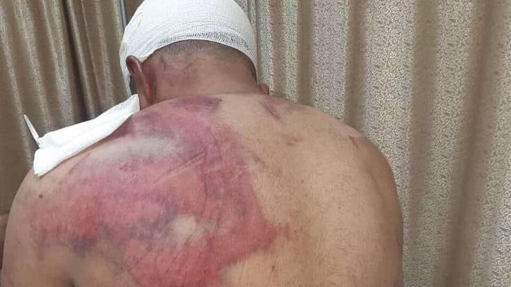 הפלסטיני שהותקף ליית' עוינה, הותקף על ידי 9 חשודים