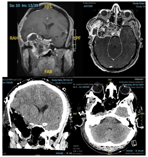 גידול מסיבי בראשו של רופא מאתיופיה הוסר בניתוח מורכב בארץ 