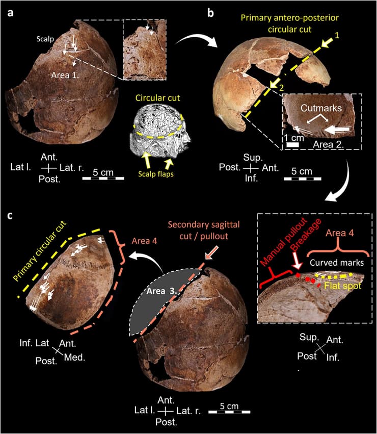 סימנים שהתגלו על הגולגולות, אשר העידו על תהליך החניטה של בני משפחת האצולה קאומון (צילום: CNRS UMR/M. Bessou) סימנים שהתגלו על הגולגולות, אשר העידו על תהליך החניטה של בני משפחת האצולה קאומון