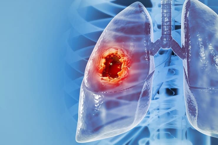 "היום הרקמות מקבלות פחות קרינה ושיעור תופעות הלוואי השתפר בהתאם" (צילום: Shutterstock) סרטן ריאות