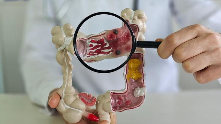 סרטן המעי הגס