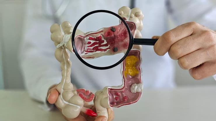 סרטן המעי הגס