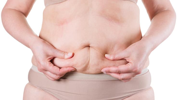 עלייה בניתוחים להסרת עור עודף, בעקבות הצלחה בטיפולים בהשמנת יתר (צילום: Shutterstock) עור עודף