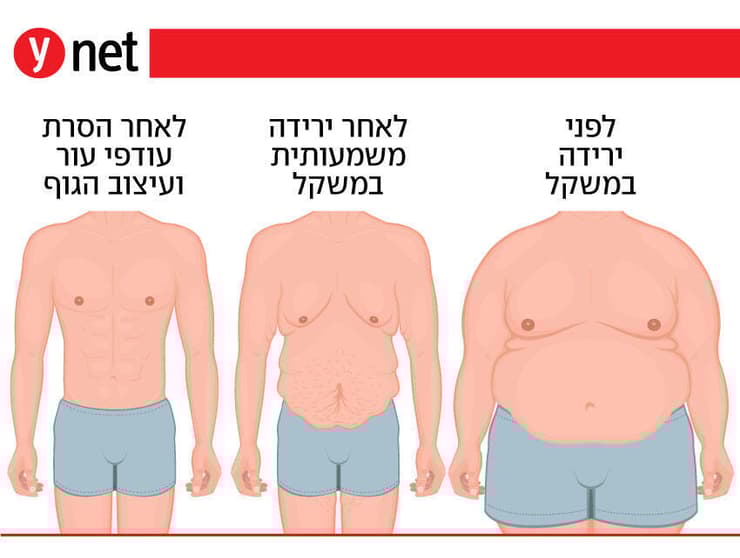 צילום: Shutterstock הסרת עור עודף