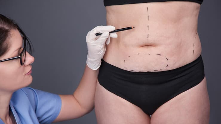 את הצלקות בעקבות הניתוח המומחים משתדלים להצניע באזורים חבויים בגוף (צילום: Shuttertock) הסרת עור עודף