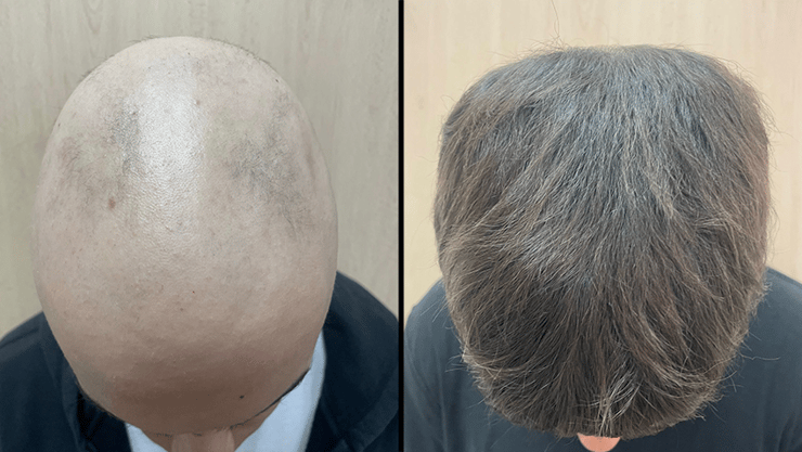 לכתבה בלבד! בן 16 עם אלופציה אראטה