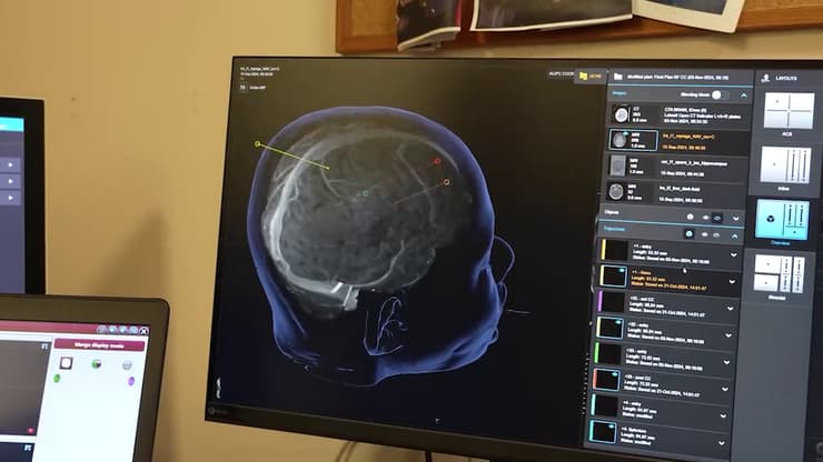 ניתוח חדשני לחולי אפילפסיה איכילוב