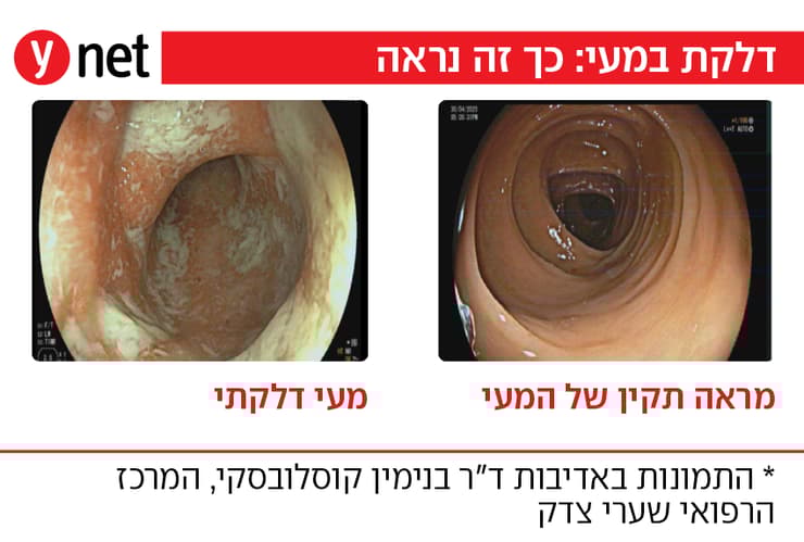 מחלות מעי דלקתיות (קרוהן, קוליטיס)