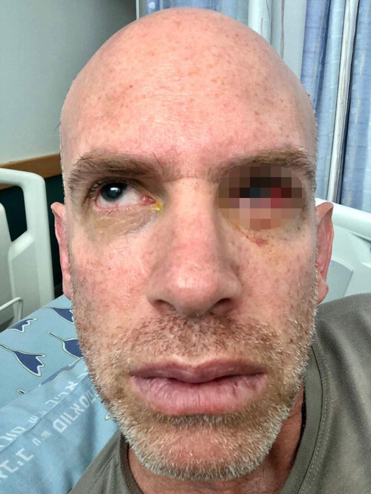 מיכאל פיש, אחרי הפגיעה שספג. "מה עשיתי, הפגנתי?" מיכאל פיש, מפגין באיילון איבד עין מהמכתזית ותובע את משטרת ישראל