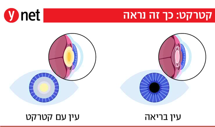 קטרקט