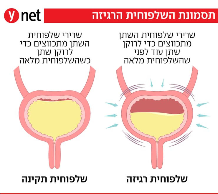 שלפוחית רגיזה