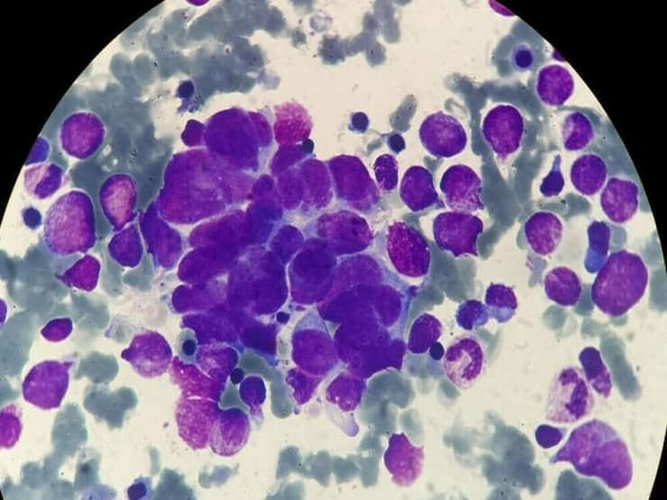 נוירובלסטומה במח העצם