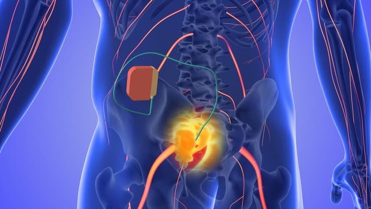 קוצב סקראלי