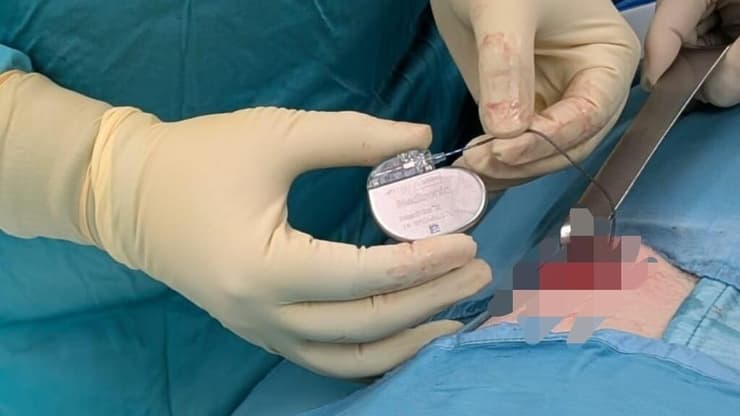 הליך השתלה של קוצב סקראלי (צילום: דוברות שמיר) קוצב סקראלי