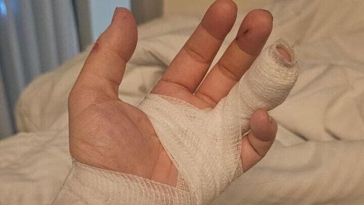 פצעותיה של צופיה דרי תושבת העיר טבריה שהותקפה בכביש 