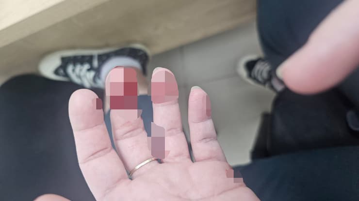 פצעותיה של צופיה דרי תושבת העיר טבריה שהותקפה בכביש 