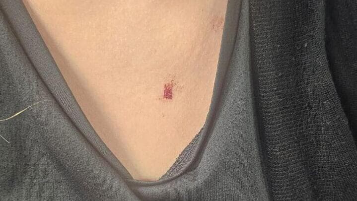 פצעותיה של צופיה דרי תושבת העיר טבריה שהותקפה בכביש 