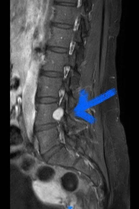 לכתבה בלבד!  כריתת גידול שפיר מעמוד השדרה (החץ מצביע על הגידול)