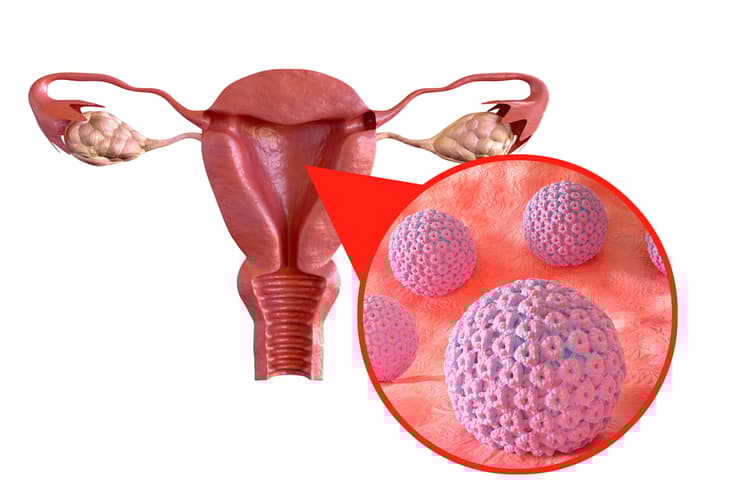 קונדילומה, HPV