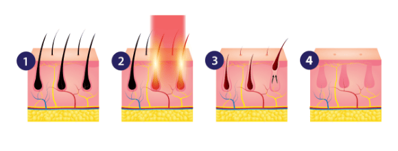 הסרת שיער בלייזר