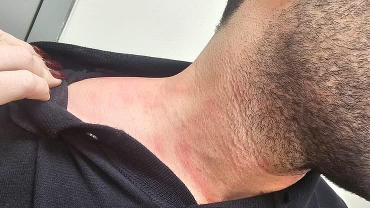 סימני האלימות שספג אחד מבקרי הגבולות במעבר אלנבי