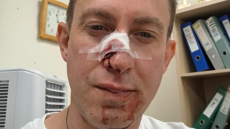 סימני האלימות שספג אחד מבקרי הגבולות במעבר אלנבי