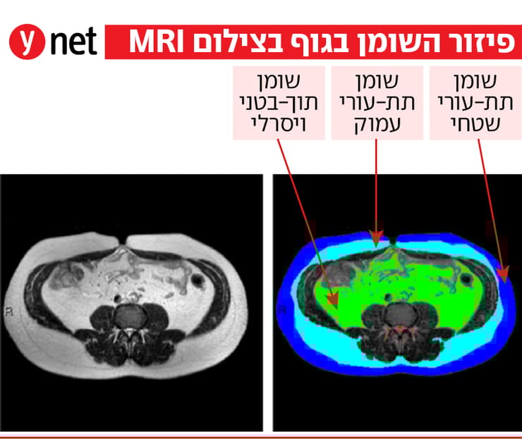 אינפו פיזור שומן בצילום הדמיה MRI