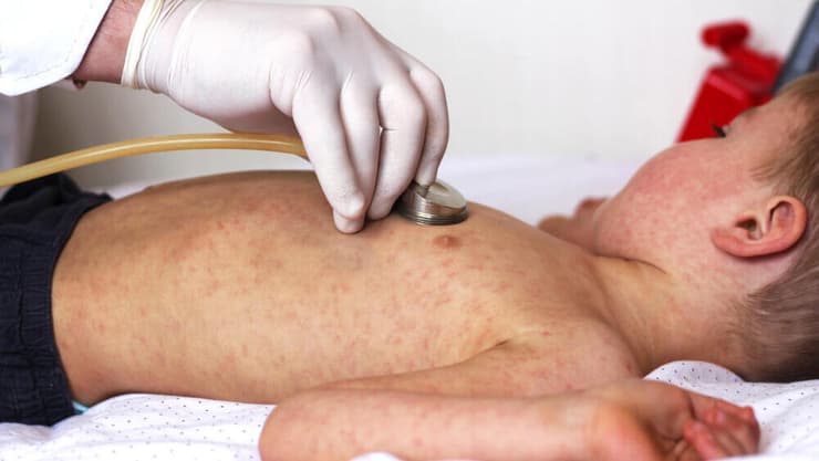 12 ילדים מאושפזים בגללל חצבת. אילוסטרציה (צילום: shutterstock) חצבת