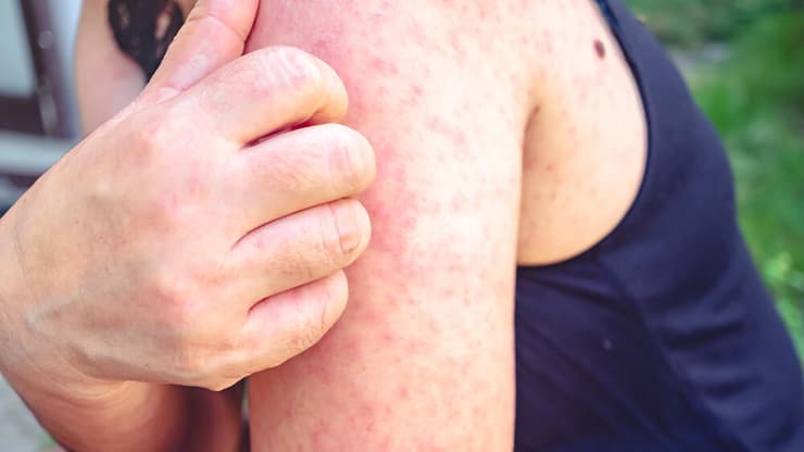 מסימני מחלת החצבת (צילום: shutterstock) חצבת