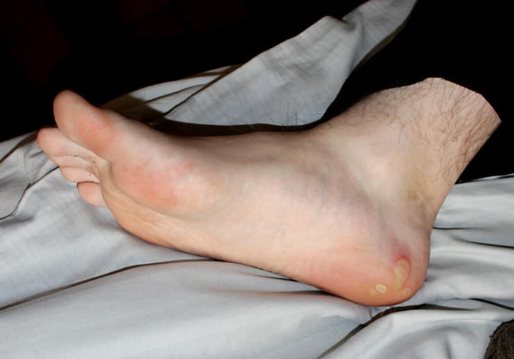 אפידרמוליזיס בולוזה סימפלקס