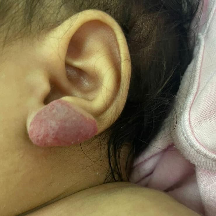 המנגיומה שגדלה בקצב מהיר בתנוך אוזן שמאל