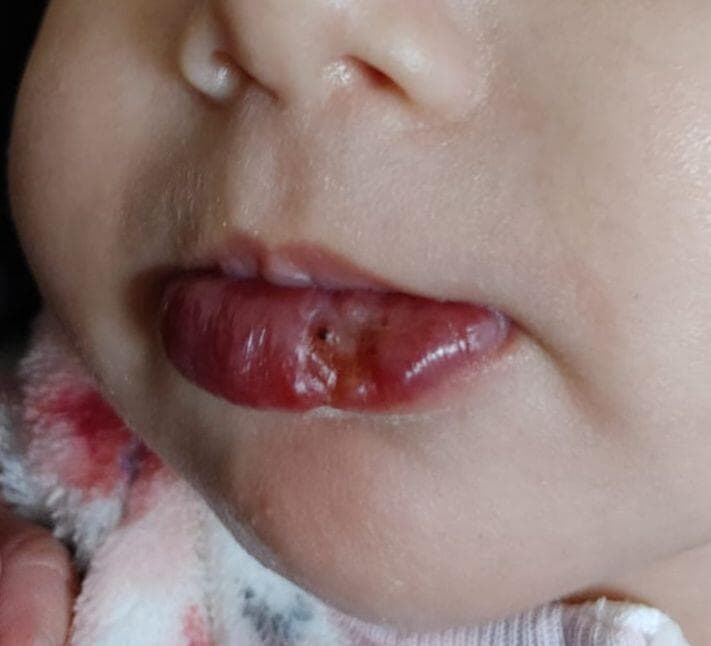 המנגיומה מכוייבת בשפה, עם כאבים בעת אכילה וקושי בעלייה במשקל