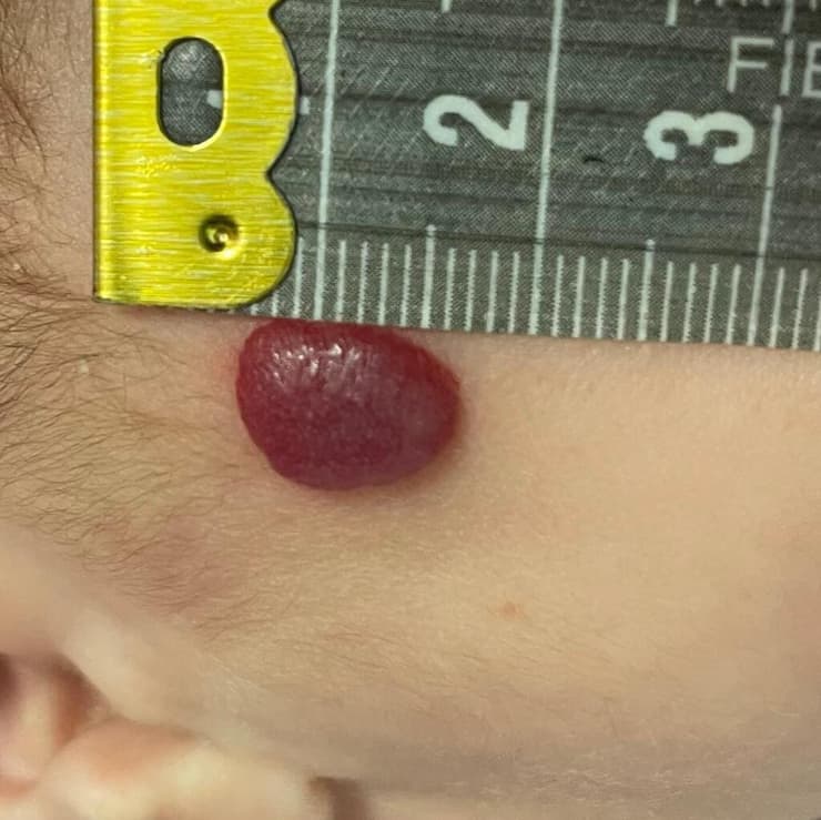 המנגיומה שטחית