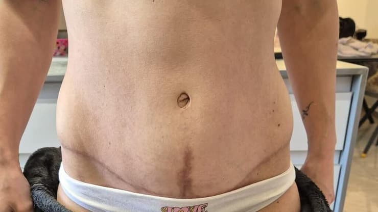 "רציתי לבחור ברופא שיהיה קרוב אליי – שיהיה לי למי לפנות אם יקרה משהו אחרי הניתוח". טל בטיטו (צילום: פרטי) טל בטיטו